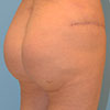 This is a procedure with solid implant to reshapes and enhances your gluteal area.