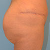 Gluteal Augmentation or solid gluteal implant is a procedure that reshapes and enhances the gluteal area.