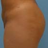 Atlanta Brazilian Butt Lift performed by Dr. Rajae Janho at Bella Forma Cosmetic Surgery Center and Med Spa.