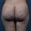 Brazilian Butt Lift Surgery after 3 Months Post Op.