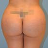 Brazilian Butt Lift surgery before and after photos.