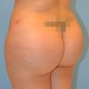 Brazilian Butt Lift performed by Dr. Rajae Janho at Bella Forma Cosmetic Surgery Center and Med Spa.