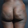 Brazilian Butt Lift - Butt Augmentation - Back - Performed by Doctor Rajae Janho at Bella Forma Cosmetic Surgery Center, Atlanta, GA
