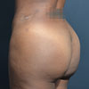 Brazilian Butt Lift - Butt Augmentation - Left Side - Performed by Doctor Rajae Janho at Bella Forma Cosmetic Surgery Center, Atlanta, GA
