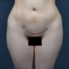 Front view on a 26 year old patient after liposuction surgery.