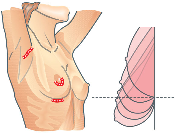 Breast Enlargement surgery or Breast Augmentation in Atlanta