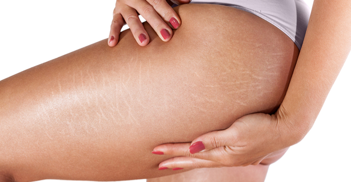 The Benefits of Stretch Mark Reduction