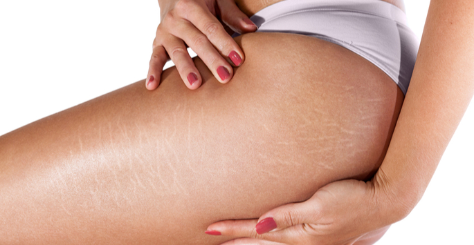 Seeking Stretch Marks Removal? Look Into Medical Camouflage