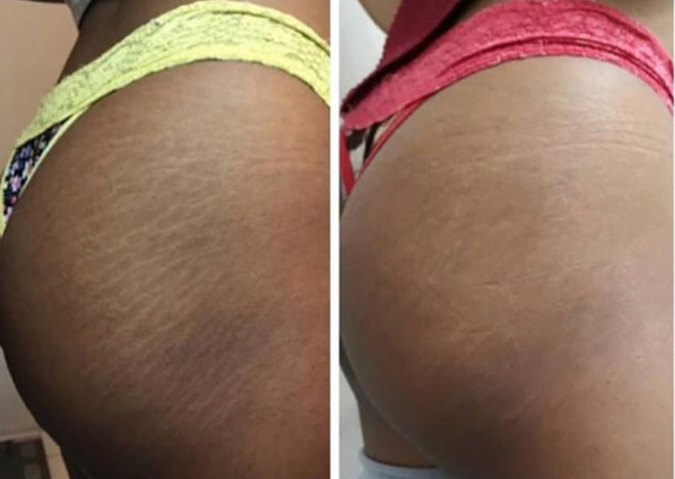 Medical Camouflage for Stretch Mark and Scars Duluth GA | Bella Forma