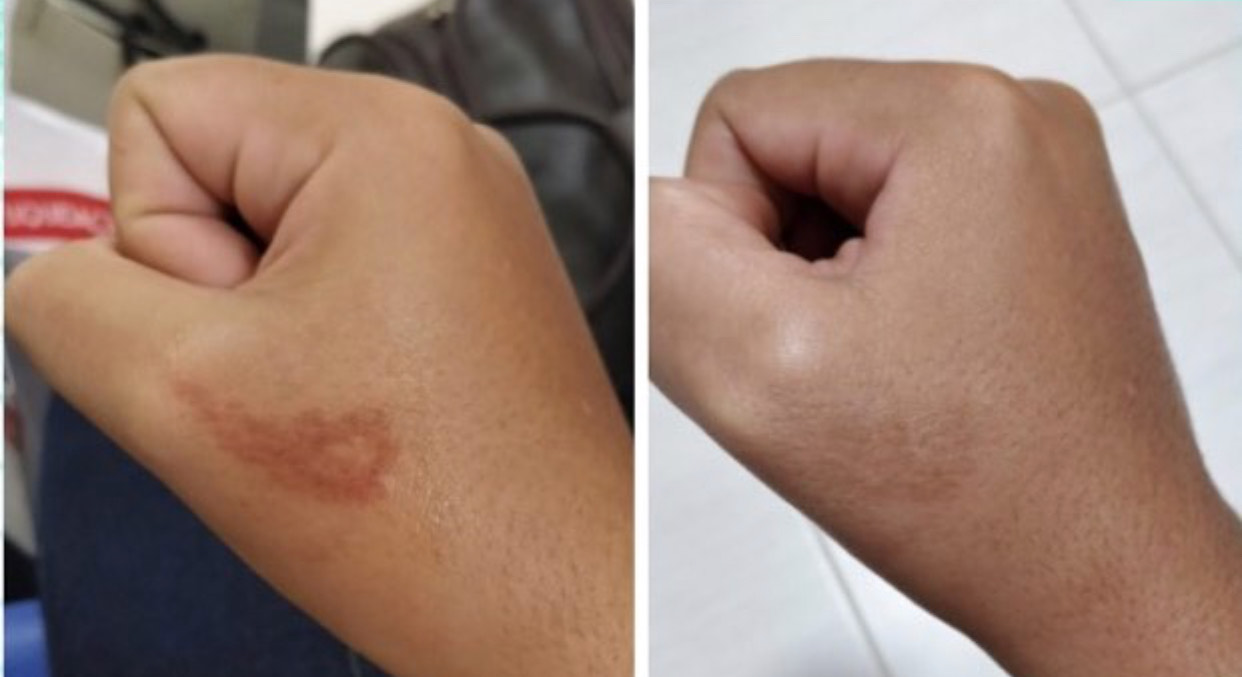 How to get rid of your Lipo Scars? Dark Scar Skin Camouflage