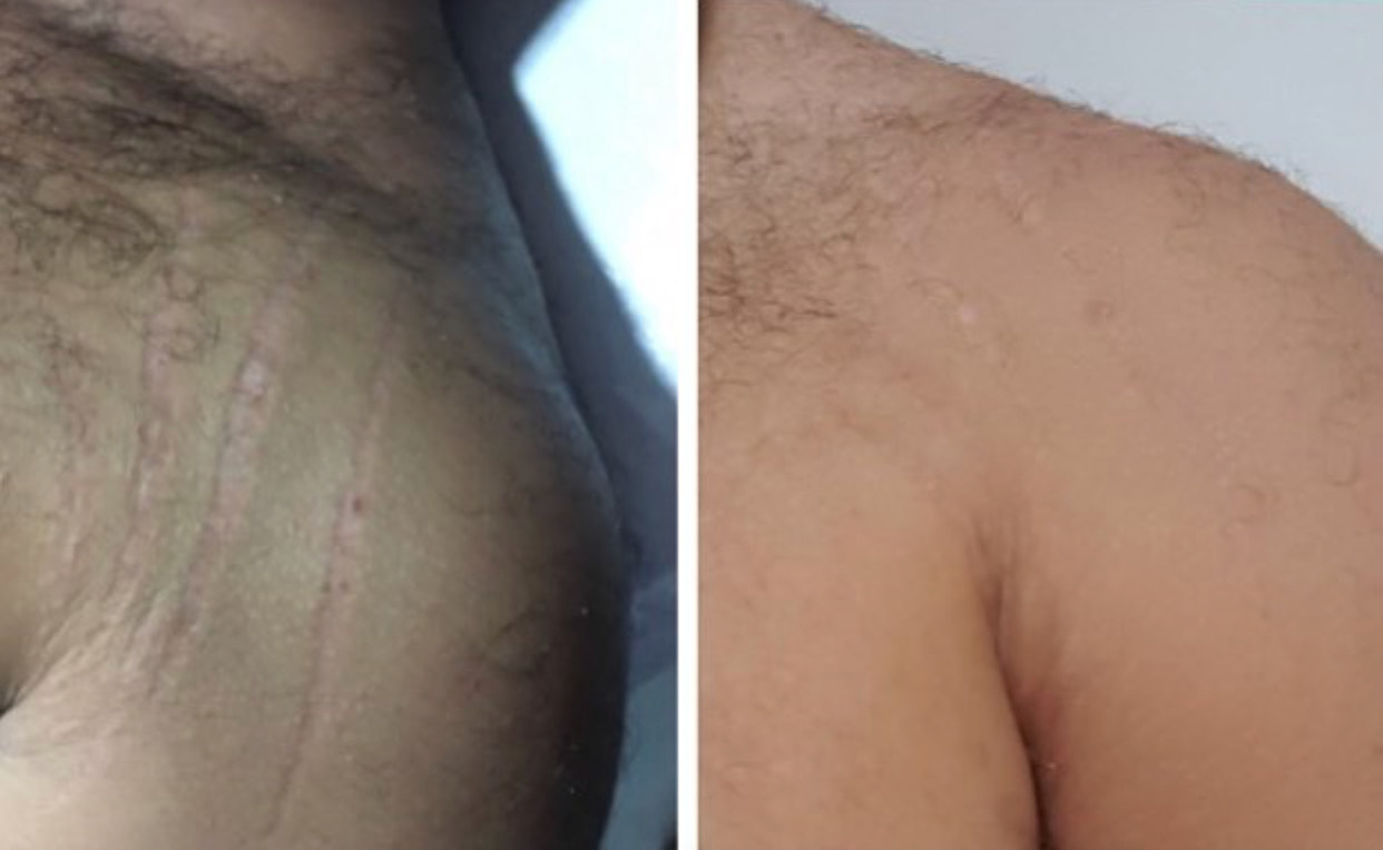 Medical Camouflage for Stretch Mark and Scars Duluth GA | Bella Forma